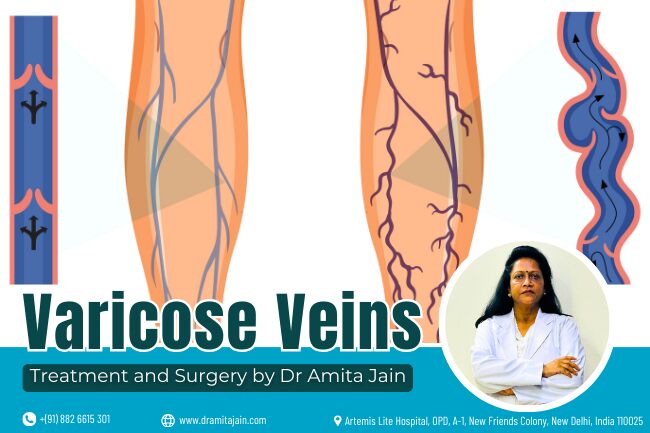 varicose veins treatment and surgery by Dr Amita Jain banner